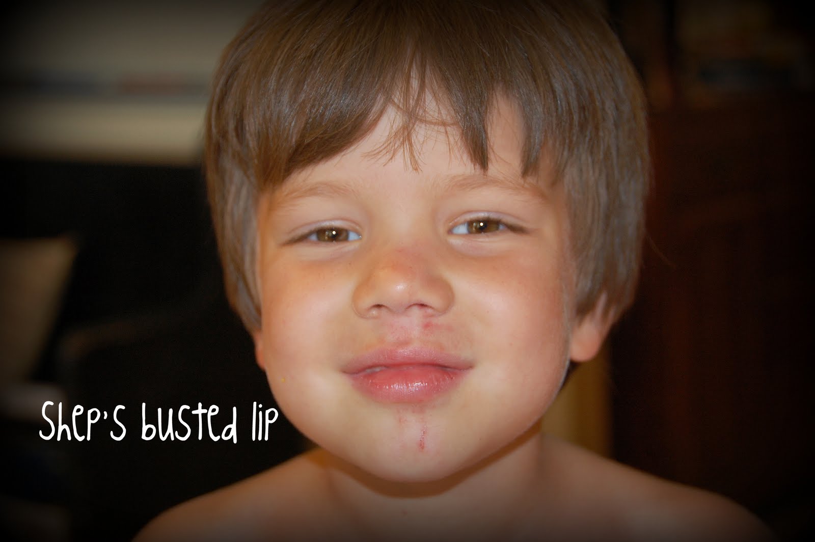 The Wassons Shep's busted lip