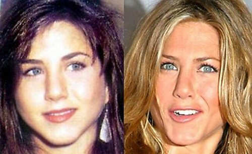 Celebrities Before And After Plastic Surgery