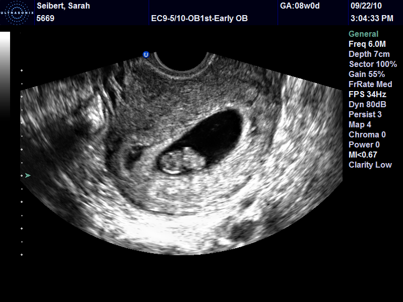 Через 6 8 недель. УЗИ 7-8 недель беременности. Снимок УЗИ на 8 неделе беременности. Как выглядит эмбрион в 8 недель на УЗИ.