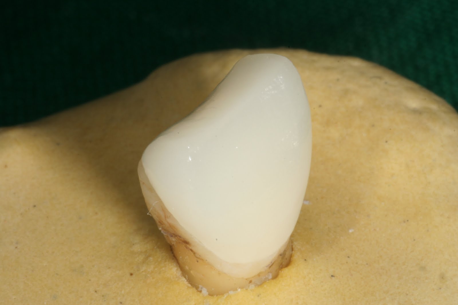 Tania's Dental Projects Ceramic veneers Colour change in luting