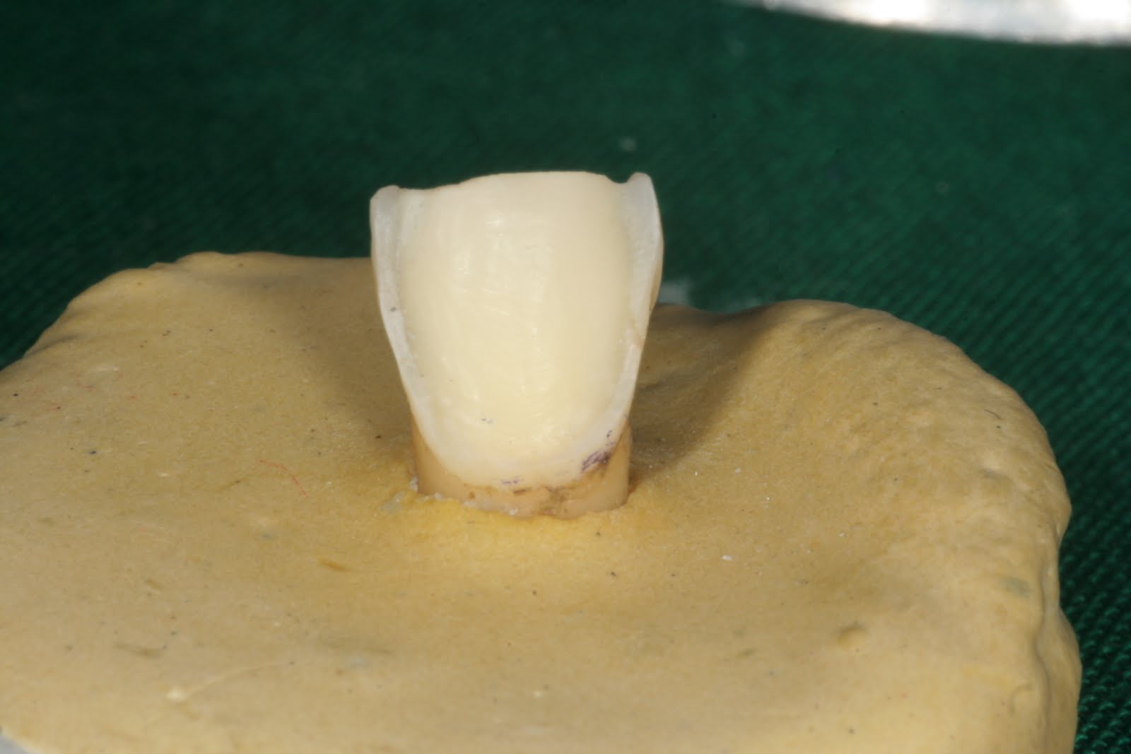 Tania's Dental Projects Ceramic veneers Colour change in luting