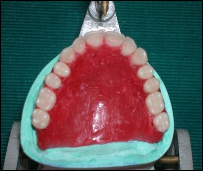 Tania's Dental Projects A New Classification of Palatal vaults A