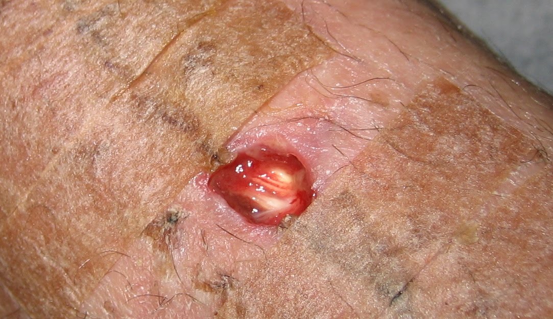 Open Wound On Penis 65