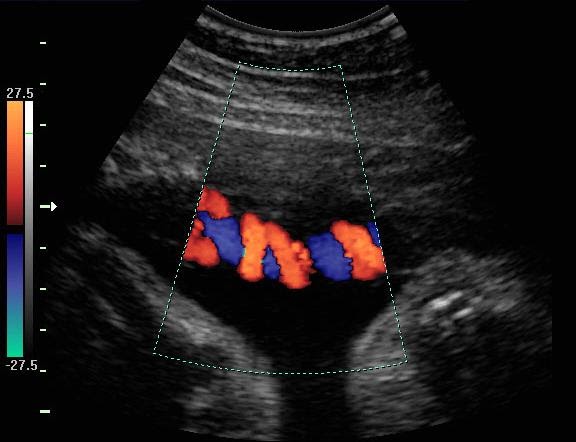 Us Obstetrica Com Doppler Colorido