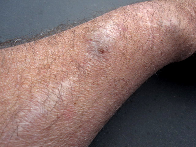 Surviving PKD: My Fistula, My Constant Reminder