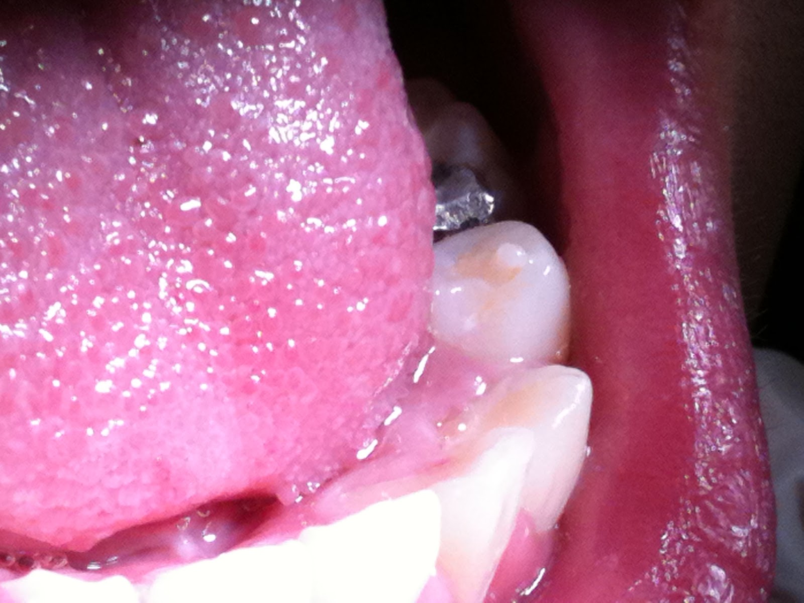 The Tooth Booth Dental Blog Dental Image Library Enamel Pearl on a