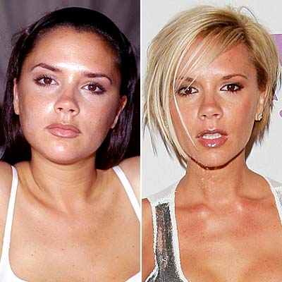plastic surgery gone celebrity when bad