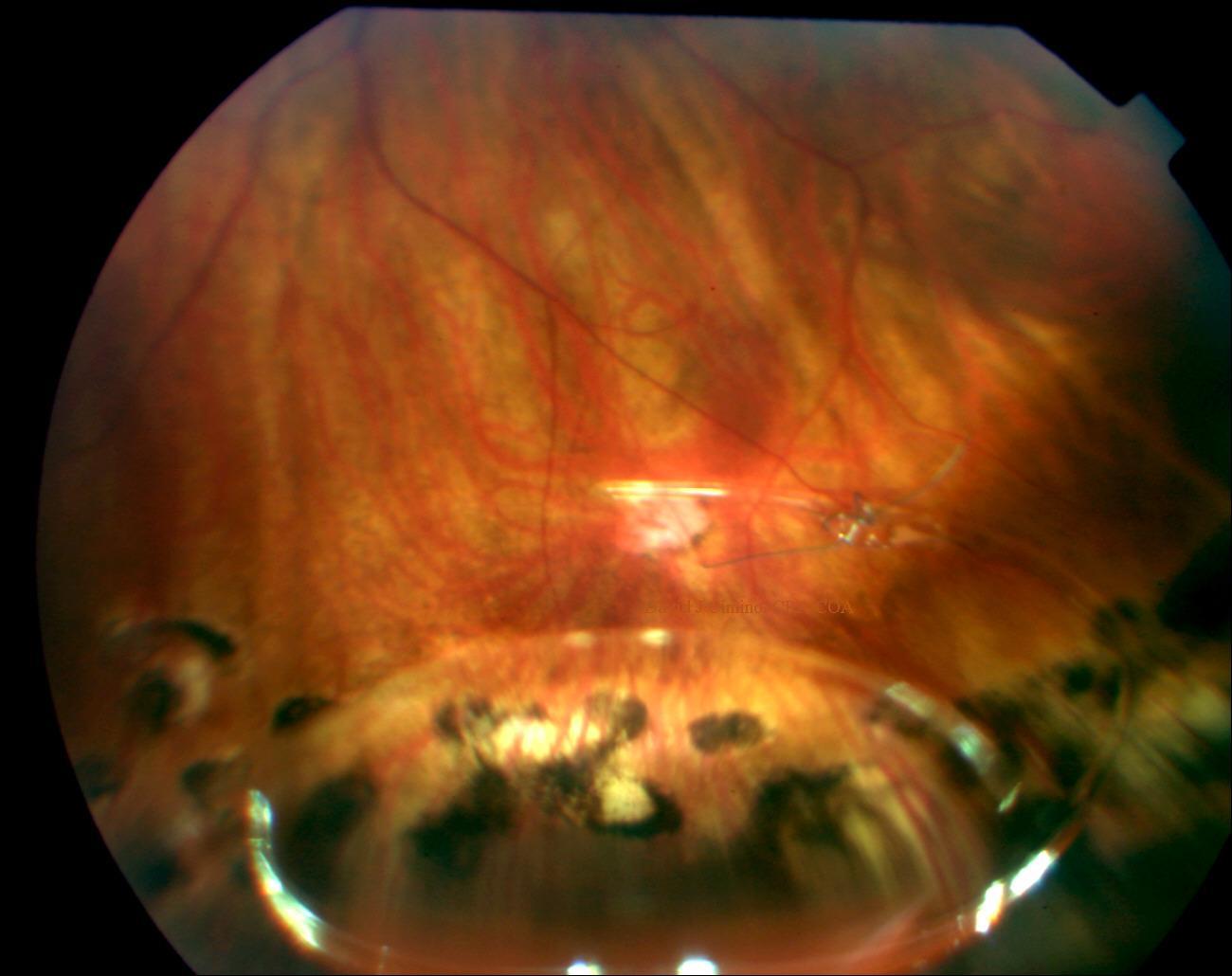 Retinal Photography & Optical Coherence Tomography