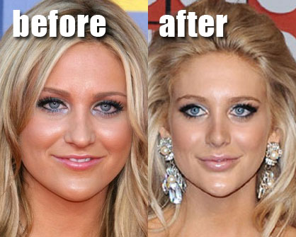 stephanie pratt before surgery after plastic celebrity lip lips fillers implants nose job breast injections facial celeb filler botched trout