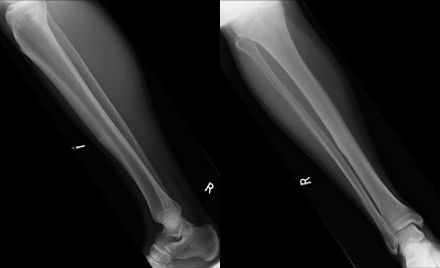 Musculoskeletal Radiology: Tibial stress fracture