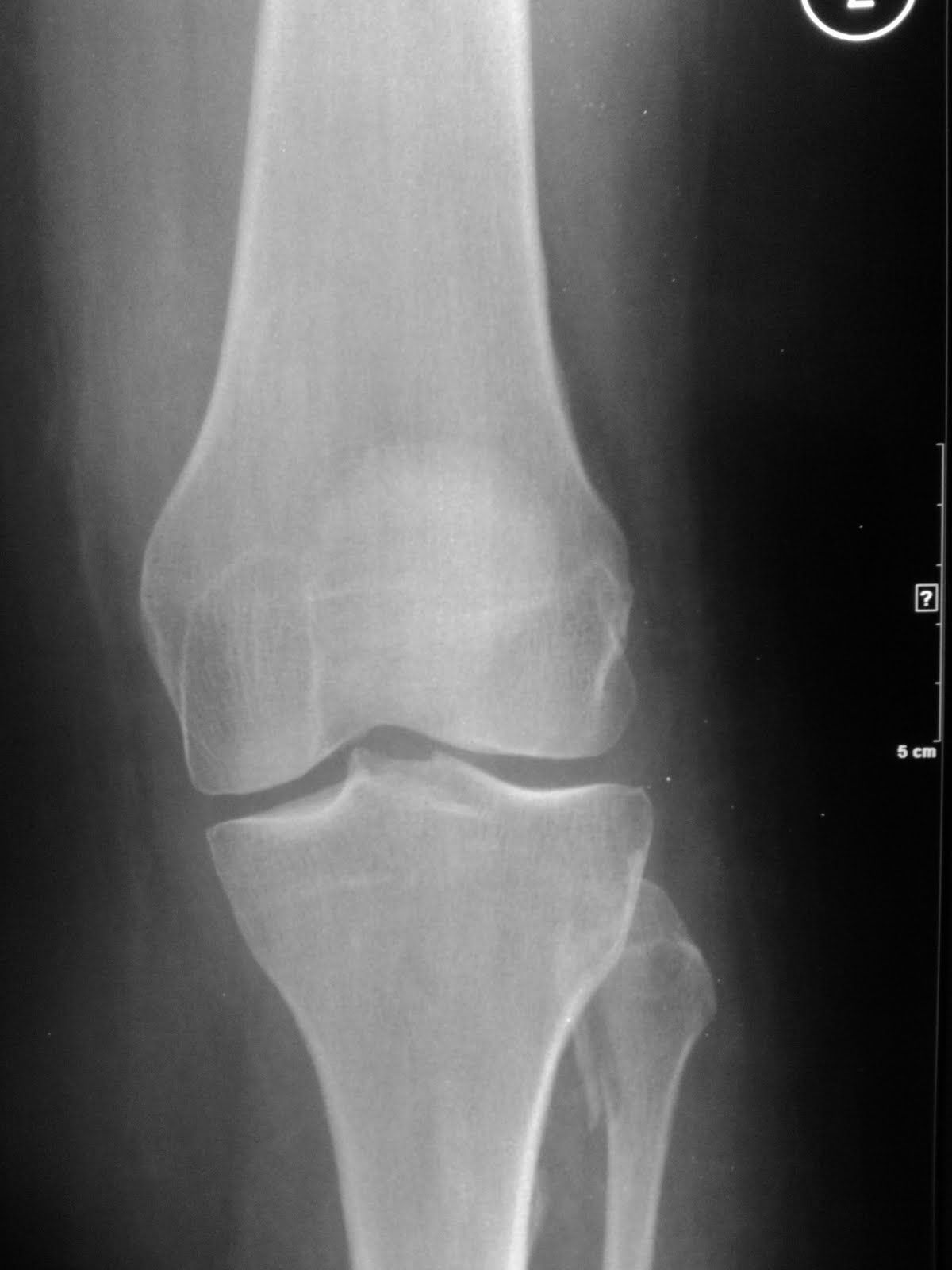 Daily Dose: Fibular fracture