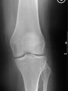 Daily Dose: Fibular fracture