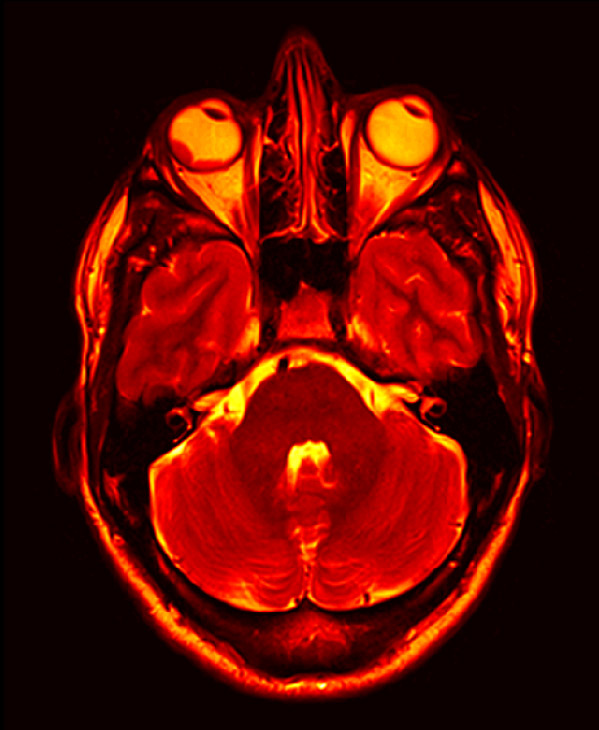 Big Trouble in Little Eyeball: A big, red eye