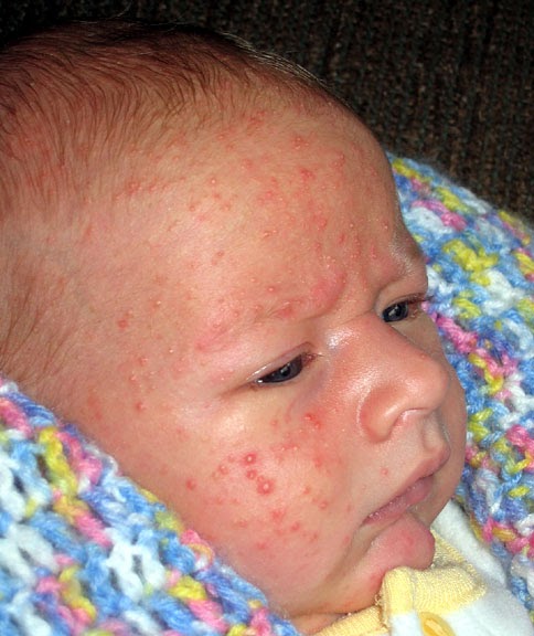 Dr Nabongs Pediatric Blog My Baby Has Acne