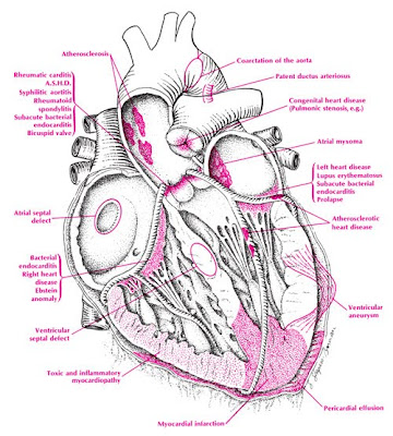 heart disease diagram. Cardiovascular Disease (CVD)