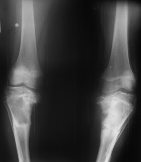 DR. CELSO RIZZI: Dupla Osteotomia para a correção da deformidade tardia ...