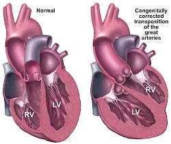 l-tga or cc-tga