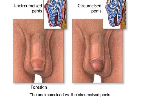 [circumcised.jpg]