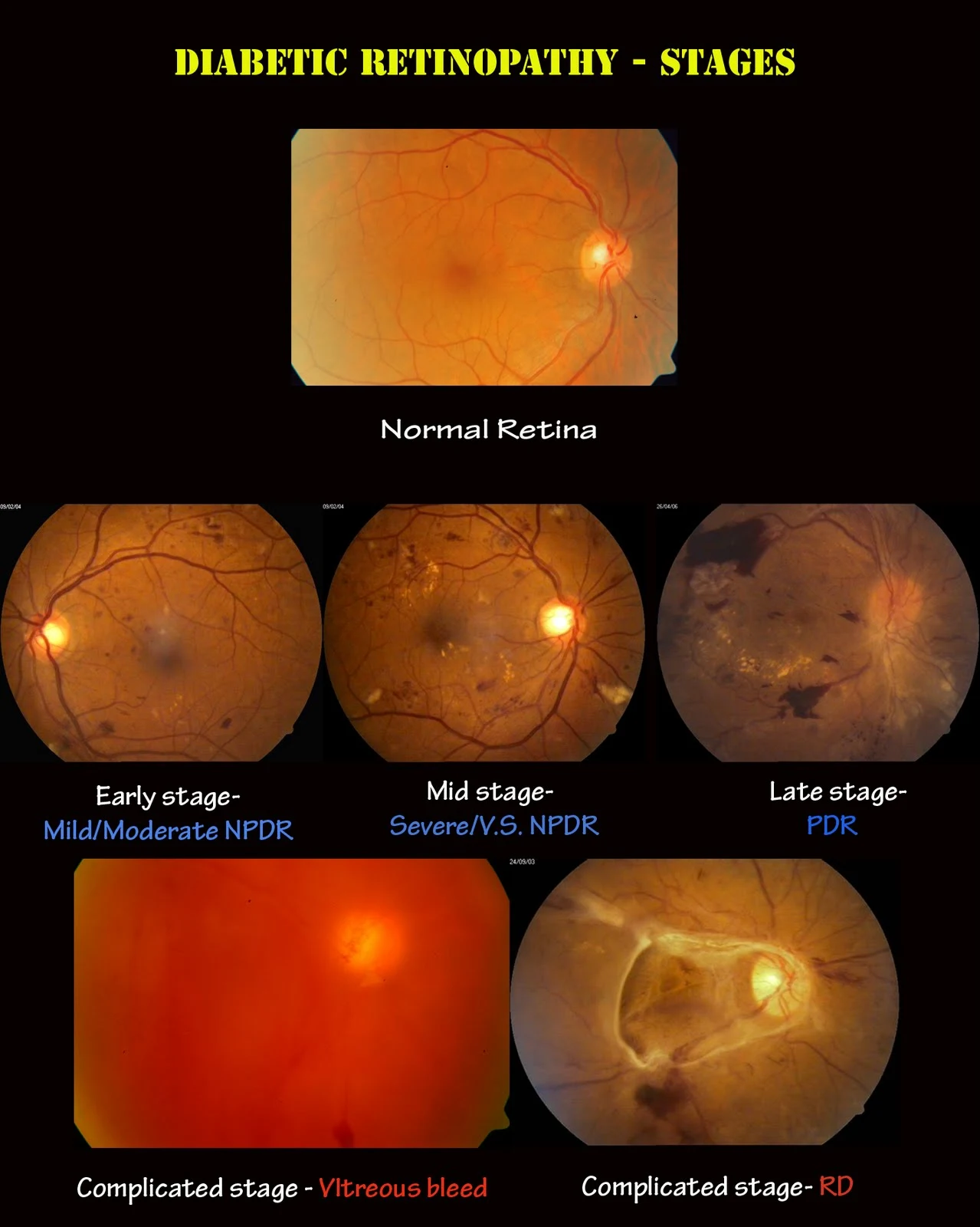 Vibrant Diabetes Retinopathy Vision Abstract Illustration