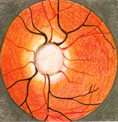 Fond d'oeil d'un glaucome