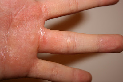 Herpes zoster (shingles) on the hand and fingers ...