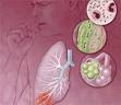 Pneumonia Nursing Diagnosis - Diagnosa Keperawatan Pneumonia