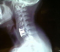 X-Ray after fusion