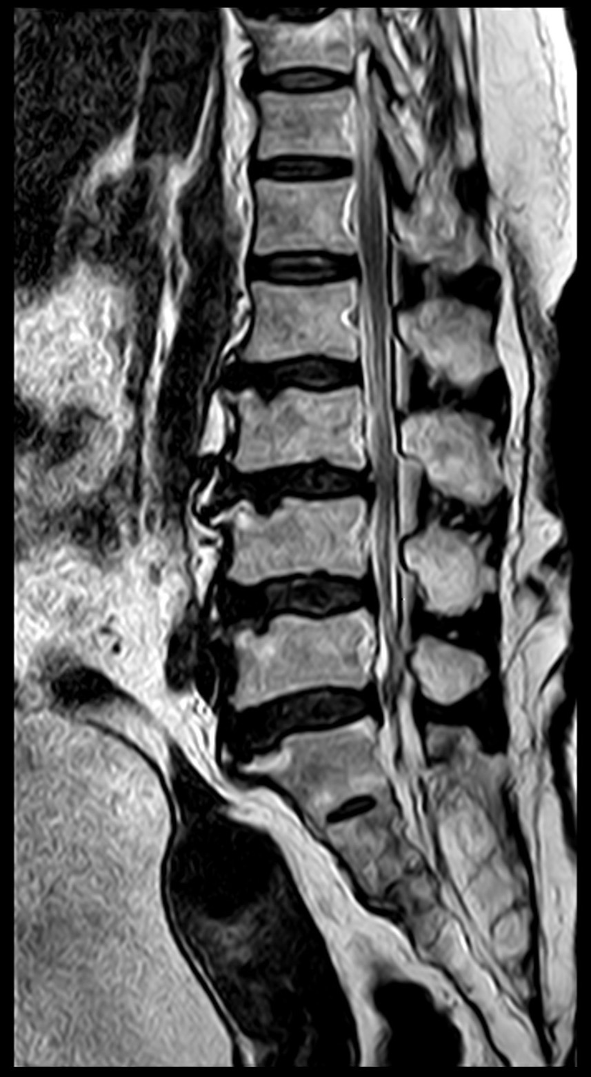 MY E-RADIOLOGY CASES: CASE 2: 72 year-old woman with severe back pain