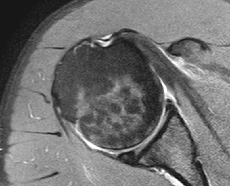 Does Hip Bursitis Show Up On Xray