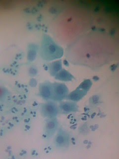que significa metaplasia escamosa madura endocervical