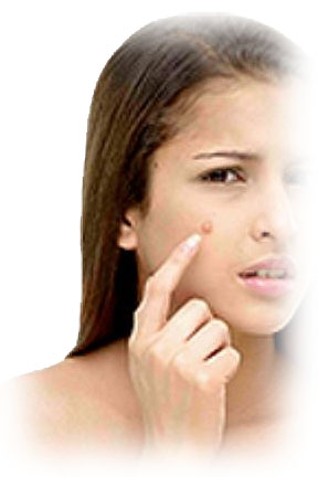 pimple1.jpg