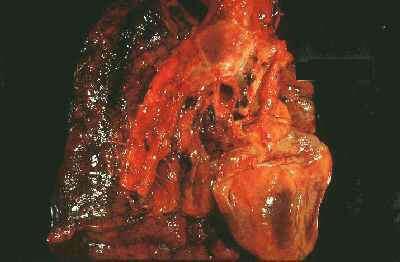 [lung21262cb7rm6.jpg]