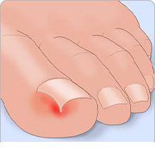 [tırnakbatması.jpg]