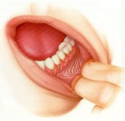 Ağız ve Ağız Hastalıkları,ağız hastalıkları tedavileri