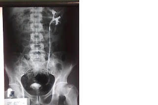 Cafe Radiologi: Teknik Radiografi RPG (Retrograde Pyelography)