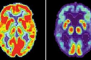 Cérebro de alguém com Alzheimer - Direito