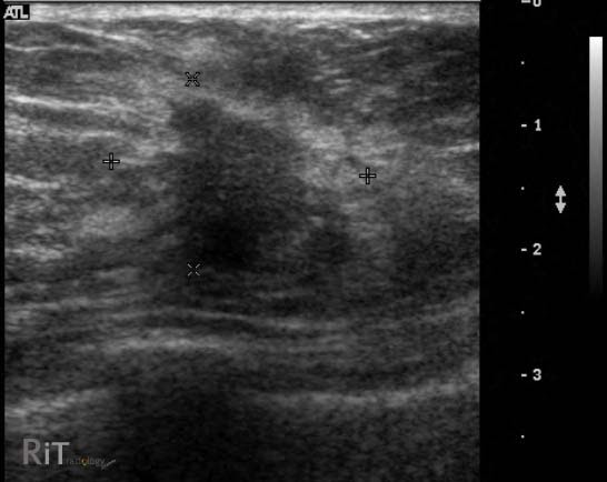 RiT radiology: Ultrasound Features of Malignant Breast Mass