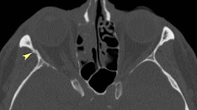 RiT radiology: Zygomaticomaxillary Complex (ZMC) Fracture