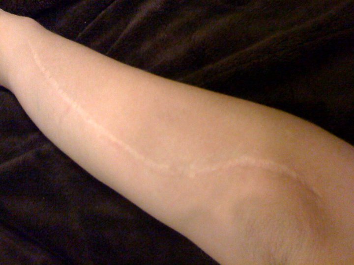 This Saga Called Life: What Does Ehlers Danlos Look Like? Here is how ...