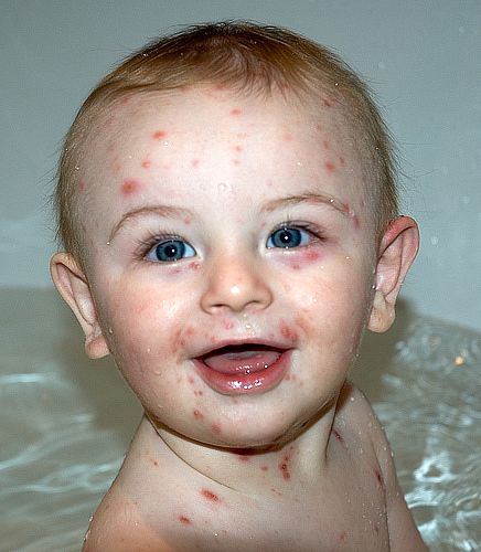 Penyakit Chicken Pox : A couple of days before this body rash may appear.
