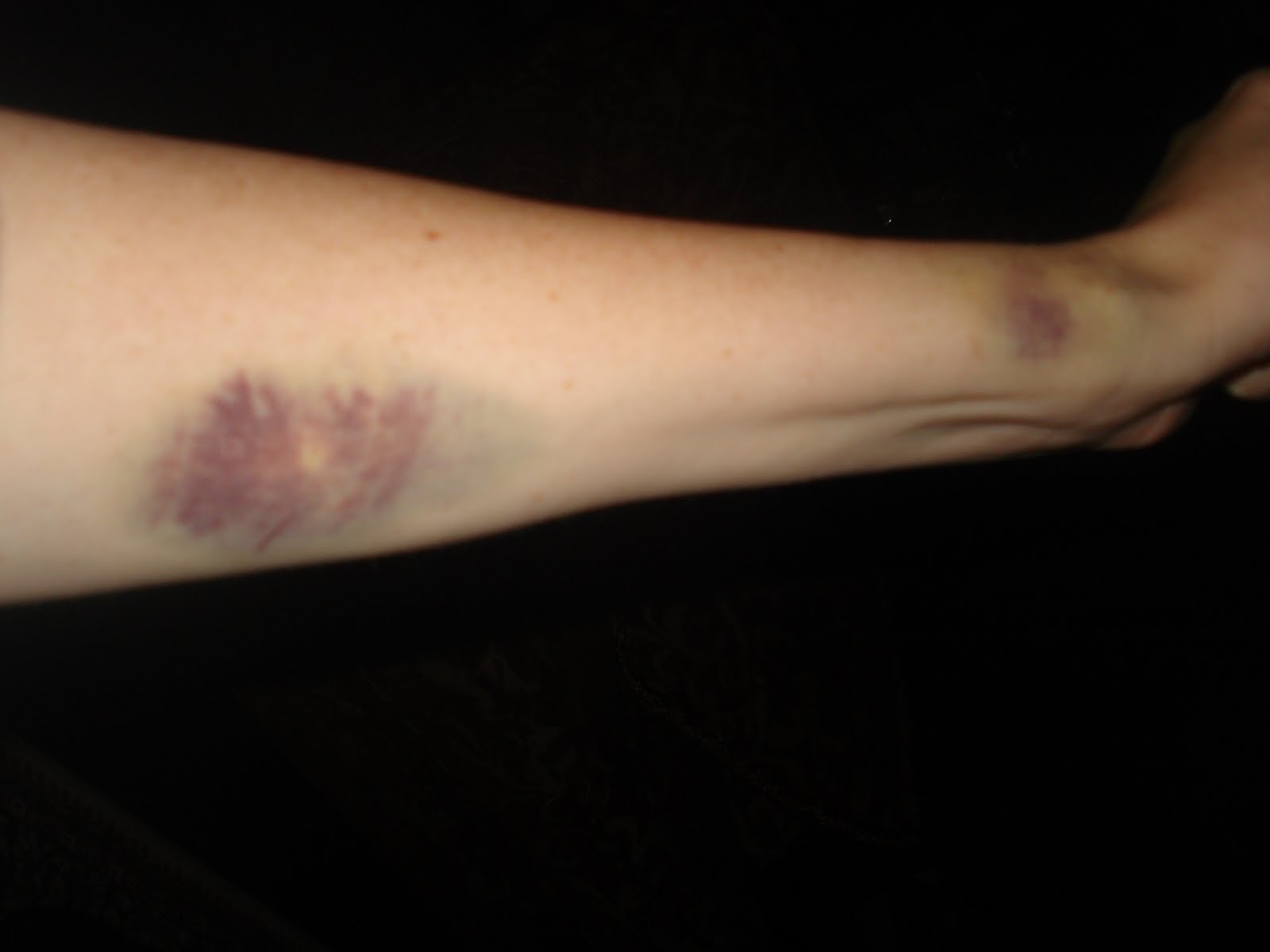 family-of-5-note-to-nurse-this-arm-bruise-is-not-my-fault