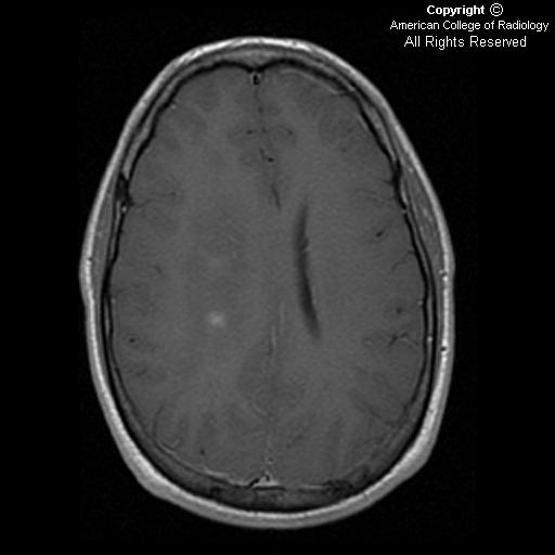 Neuroradiology On the Net Gliomatosis cerebri