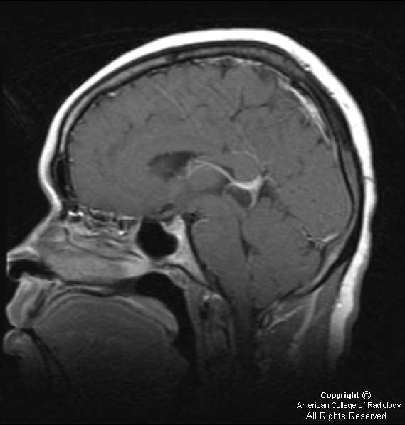 Pineal Cyst