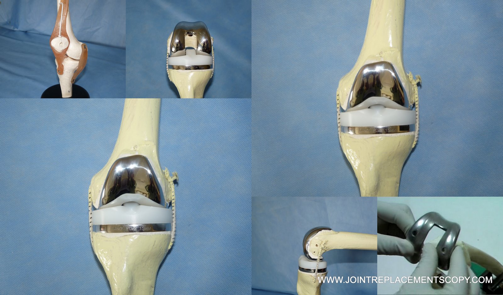 joint care foundation Demo Knee Joint Replacement