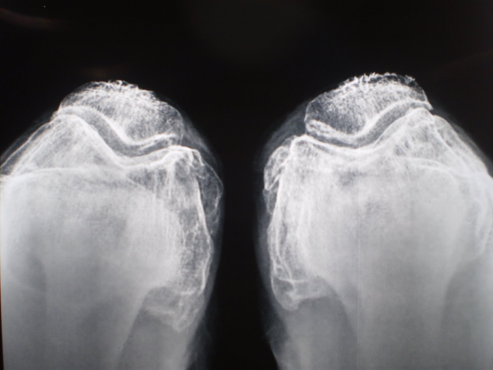 joint care foundation Knee Joint Arthritits 2