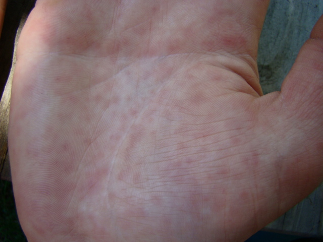 Hand-Foot-and-Mouth Disease-Topic Overview - WebMD