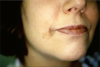 Diseases-causes&cure: Pigment Diseases