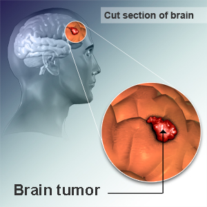 symptoms of brain cancer