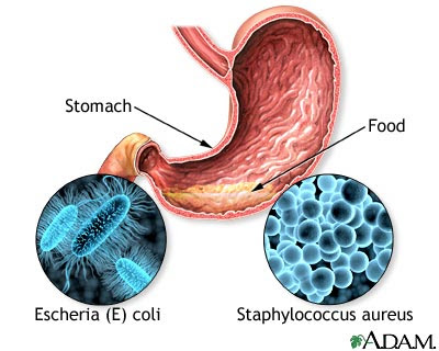 Lactose Intolerance After Food Poisoning Lactose Intolerance After Food Poisoning