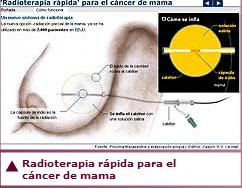 Radioterapia Rápida para el Cáncer de Mama